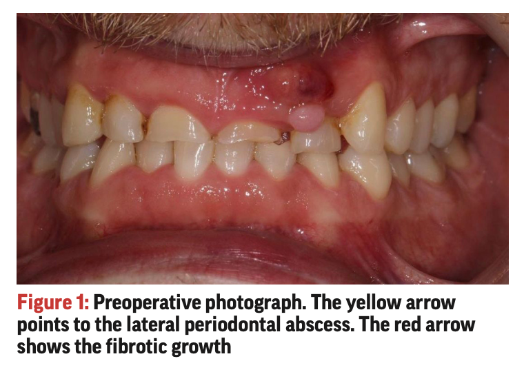Functional crown lengthening