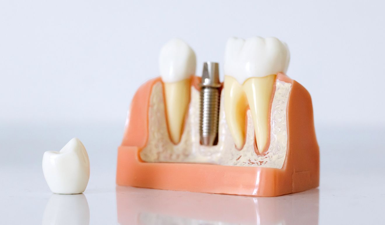 services implant dentistry hero cbefb933